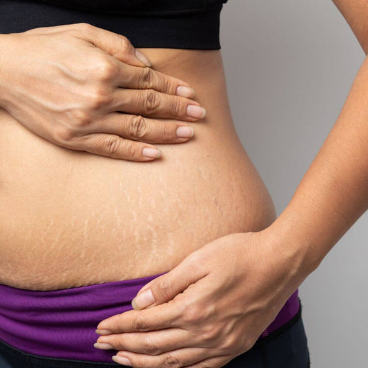 stretchmarks on a lady's skin